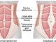 Divarication Recti Rectus Divarication | Norfolk & Waveney Community Musculoskeletal ...