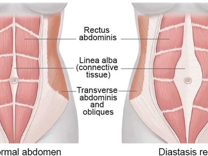 Divarication Recti Rectus Divarication | Norfolk & Waveney Community Musculoskeletal ...
