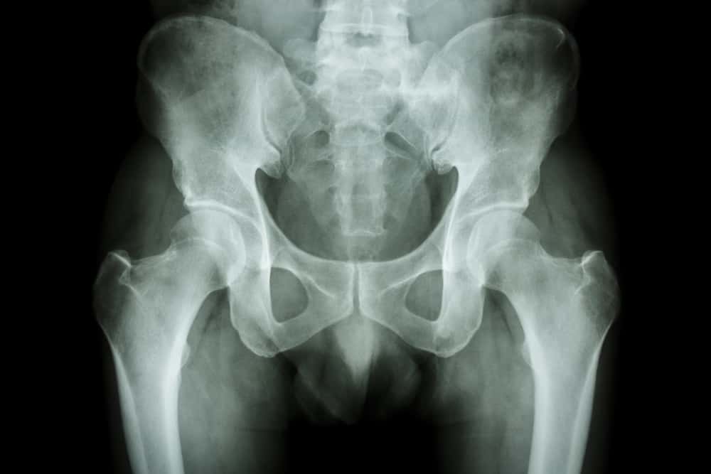 X-ray of hips