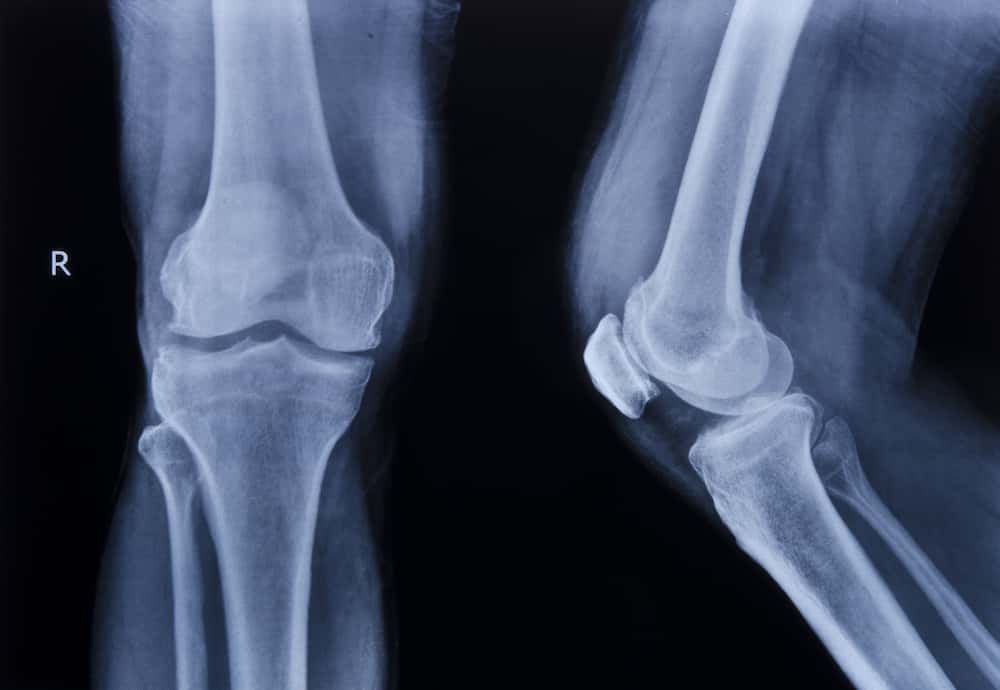 X-ray of a partial knee replacement with front and side view of the knee bones.