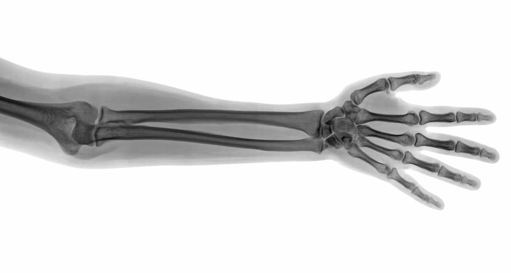 X-ray of an arm from the elbow down to the hand.